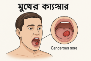 Read more about the article মুখের ক্যান্সার: মুখের ক্যান্সারের লক্ষণ, কারণ, প্রতিরোধ ও চিকিৎসা সম্পর্কে বিস্তারিত জেনে নিন
