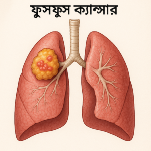 Read more about the article ফুসফুস ক্যান্সার: ধূমপান ছাড়াও যেসব কারণে ঝুঁকি বাড়ে, সতর্কতা খুব জরুরী, ফুসফুস ক্যান্সারের কারণ